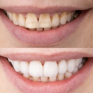 cosmetische tandheelkunde