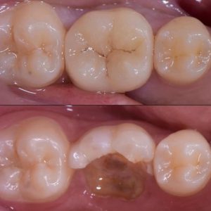 dentacare kronen