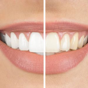 dentacare tanden bleken
