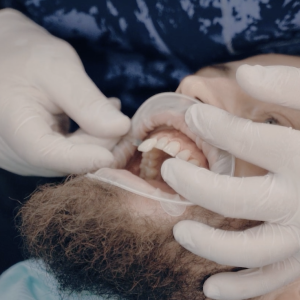 dentacare veneers